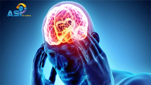 كيف يفاقم الصداع النصفي خطر الإصابة بالسكتة الدماغية؟